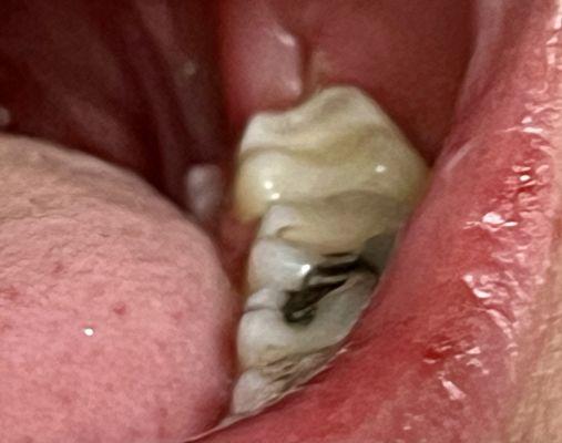 After surgery, a fragment? of bone sticking out of the gums where a wisdom tooth had been (behind last tooth).