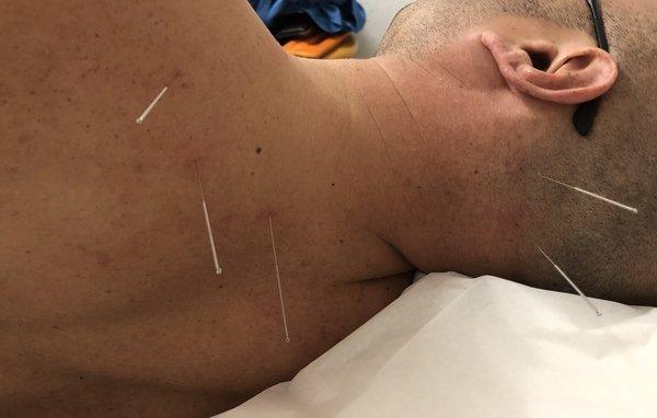 5 acupuncture sites for unilateral neck & shoulder pain that wouldn't go away.  3 sessions later, 100% relief  :)