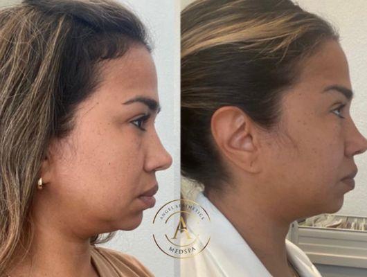 Nefertiti neck lift is an exciting, non-invasive procedure that can delicately but efficiently revitalize your neck and define your jawline