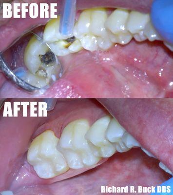 White Composite Filling done by a Rancho Cucamonga Dentist to Look natural.