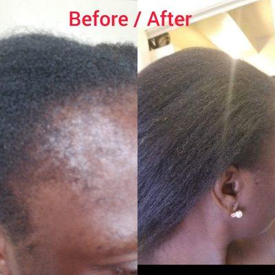 #tractionalopecia
#hairlosstreatment
#certifiedtrichologist
#hairrestoration
#hairthinning