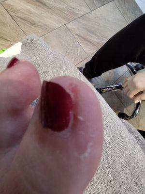 Dead skin and uneven toenail