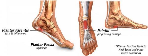 Plantar Fasciitis