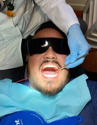 Finally, finished my 6-month Invisalign plan with Dr. Mojica.