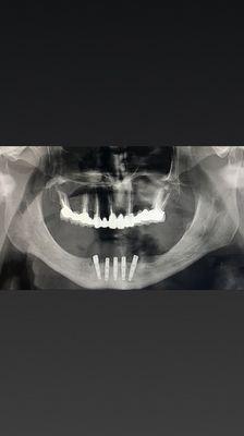 Same day "Teeth ". Patient had implants placed and crowns same day in lower jaw.