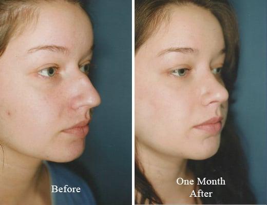 Rhinoplasty before and after