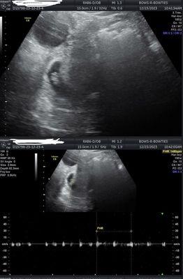 6+ week ultrasound