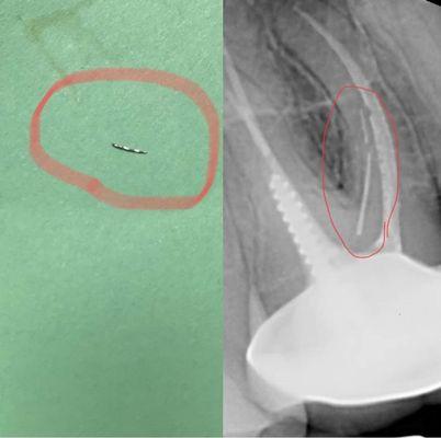 I lost a molar tooth because of this negligent dentist. She left two pieces of broken needles inside the roots.