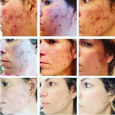 BBL AND MOXI Lasers . Downtime diary days 1-9. Achieve youthful GLOWY skin in just 9 days!