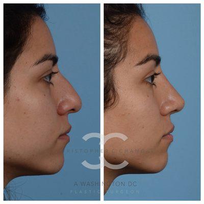 Rhinoplasty 3 months after surgery