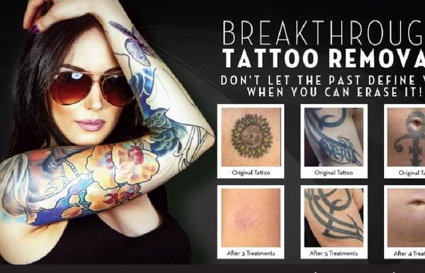 Remove your tattoo in half the time of traditional lasers. We can treat the widest range of ink colors, even tattoos that wer...