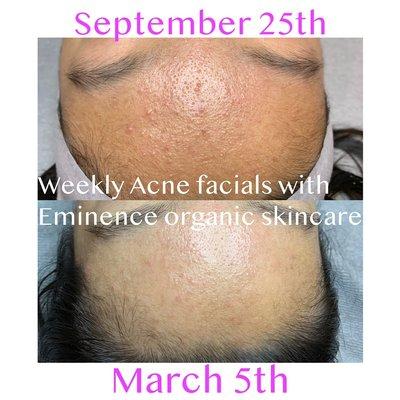 Weekly acne facial with Eminence natural organic skincare products. :)