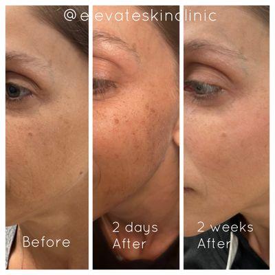 Limelight IPL results, stages of healing