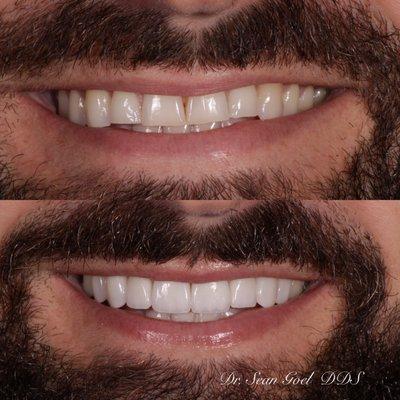 Beautiful Porcelain Veneers