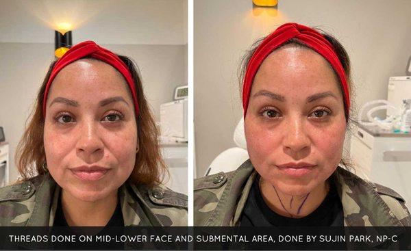 Mid-Lower Face Thread Lift