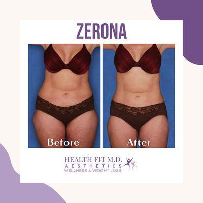 Zerona Z6 is a full body fat loss treatment, applied externally, that targets areas of stubborn fat. It is the first laser specifically desi