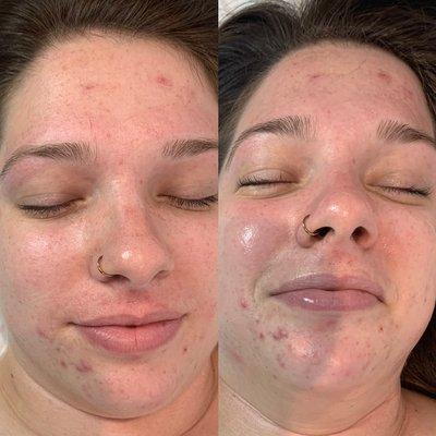 Before and after Everyday Facial with dermaplaning and extractions.