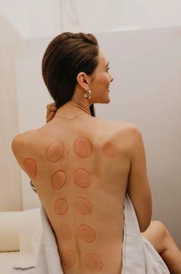 Cupping Therapy