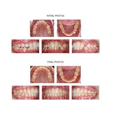 Adolescent with crossbite, severe crowding and impacted cuspid teeth treated with four bicuspid extractions and braces.