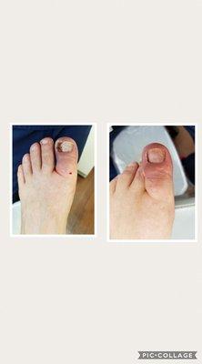 Before and After Ingrown toenail Surgery