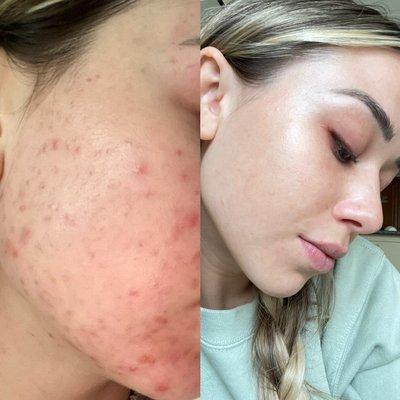 Acne transformation.