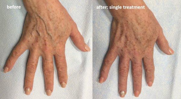 Dr. Malvehy treats bulging hand veins in a single 15 minute visit.