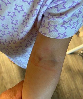 Daughter's bruised arm