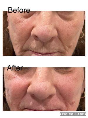 under eye and cheek before and after filler