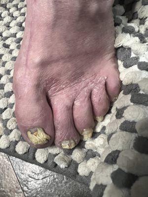 My brothers feet has been like this for years still no fix.