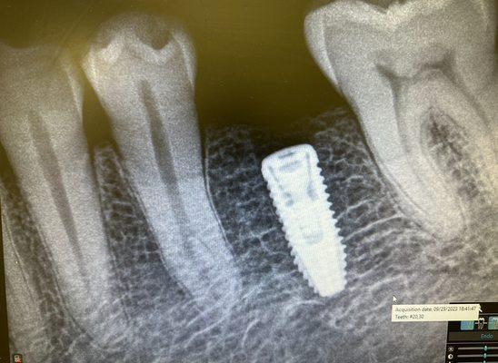 3D Guided Implant Placement, minimally invasive. No trauma, protecting all important anatomical landmarks and the nerves.