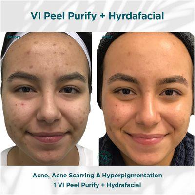 VI PEEL 
Acne, Acne scaring and Hyperpigmentation