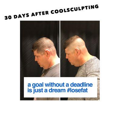 This is a before and after of CoolSculpting on the chin.