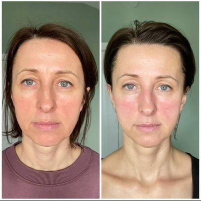 Before/after 1 treatment