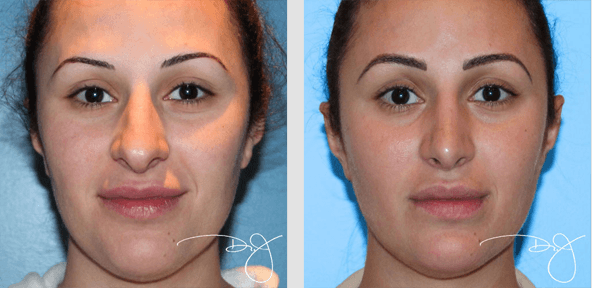 Rhinoplasty