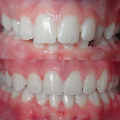 With braces Team Orthodontics achieved:
Deep bite correction
Crowding correction
Midline correction 
Straight teeth
A beautiful smile