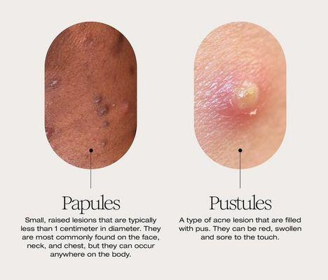 Papules Vs Pustules