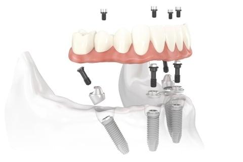 dental implants to replace an entire arch of teeth.