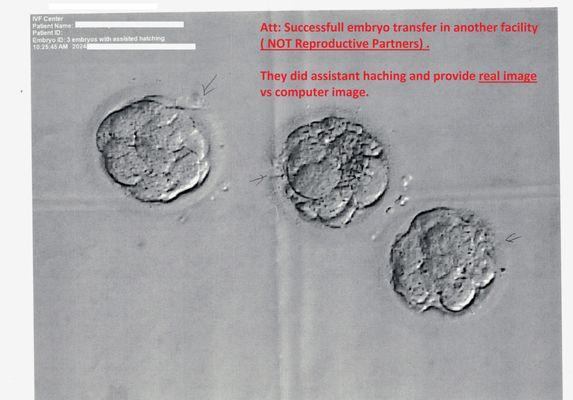 Successfull IVF trafer in another clinic. They were very transparent from day 1 and shared real image of the embryo