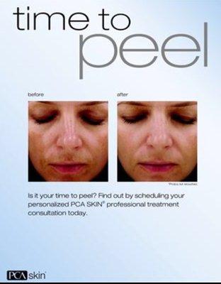 Is it time for a peel ?? Peels for every skin type. Sensitive skin too!