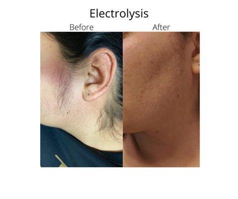 Electrolysis Hair Removal