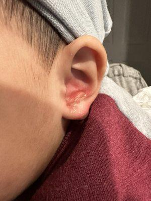 Look at the intense redness and the blister form on his ear.