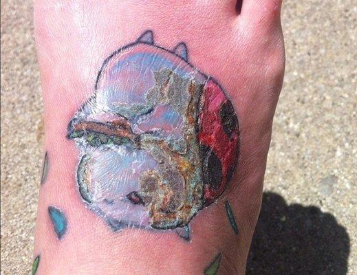 Infected tattoo, ewwww