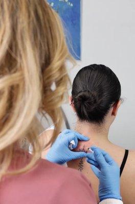 Kybella treatment for "buffalo hump"