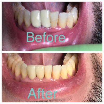 Unhappy with his original crowns, later found out they were causing gum issues. The health of his smile has improved & so has his happiness!