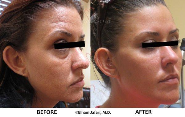 Liquid Facelift with combination of Botox/Dysport and filler injected in the temples, under the eyes, cheeks, and forehead.(Voluma/Volbella)