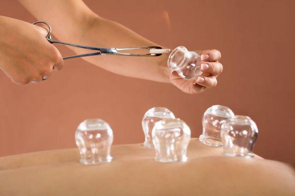 Cupping Therapy