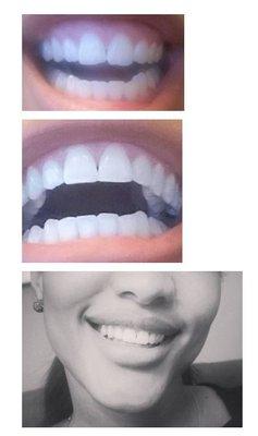 Before (top) & After (bottom 2 pics) - chip repairs to both top front teeth!  Great job Artistic Smiles of GA!!!