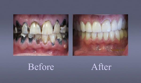 Full mouth restoration