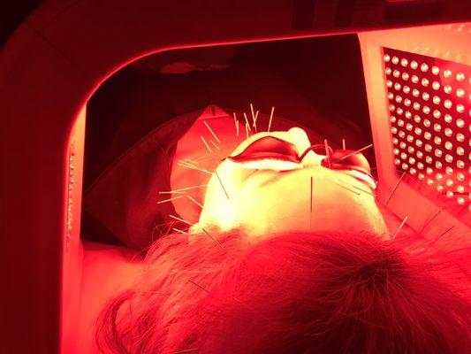 Facial Cosmetic Acupuncture & LED light therapy