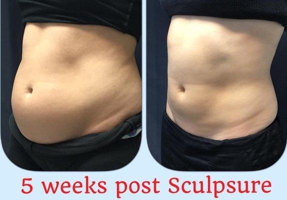 Sculpsure Before and After